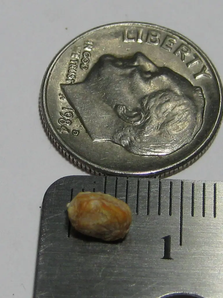 Kidney stone size comparison