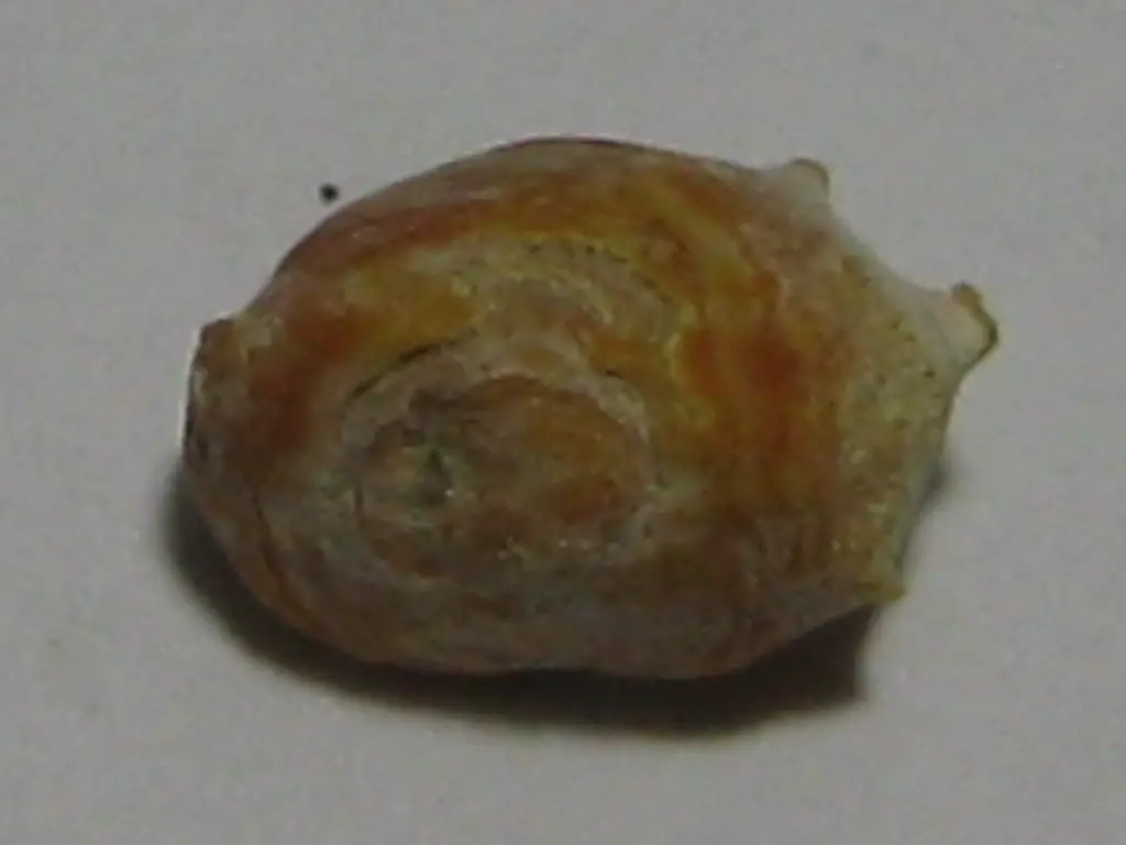 Kidney Stone